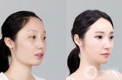 磨腮削骨多少錢？腮幫子磨骨多少錢？