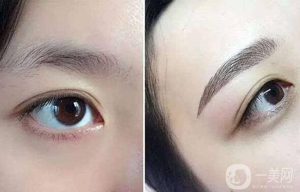 北京眉整形多少錢？價格是多少？