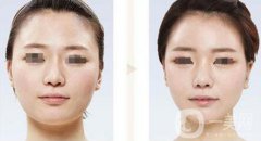 臉部削骨手術(shù)多少錢 削骨瘦臉手術(shù)價(jià)格詳情