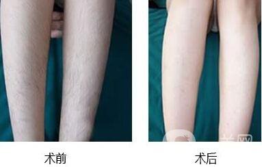 激光脫毛,價(jià)格