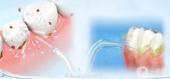 洗牙的利與弊 洗牙的優(yōu)點(diǎn)和缺點(diǎn)
