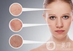 *風(fēng)范祛斑果怎么樣？