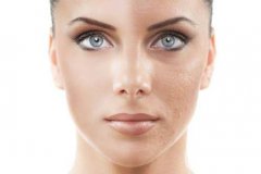 果酸換膚的危害 后遺癥主要有哪些？