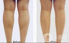 打注射瘦腿一般需要多少錢