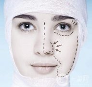 上海一個(gè)鼻部手術(shù)大概多少錢？?jī)r(jià)格盤點(diǎn)！