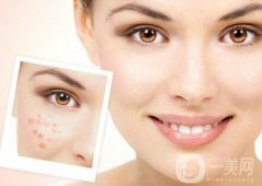 像素激光調(diào)節(jié)痘坑果怎么樣？