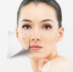像素激光調(diào)節(jié)痘坑*果怎么樣？