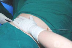 超聲波抽脂*嗎？有什么風(fēng)險(xiǎn)？