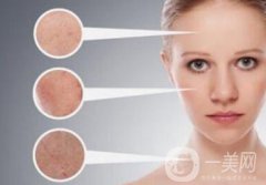 像素激光祛斑價(jià)格一般是多少？果好嗎？