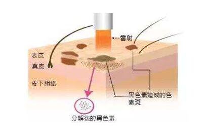 像素激光祛斑,價格