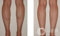 在上海注射瘦臉瘦小腿需要多少錢