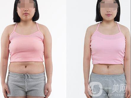 超聲波抽脂價(jià)格多少？超聲波抽脂有什么優(yōu)點(diǎn)？