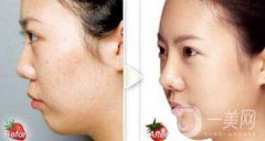 正規(guī)醫(yī)院做果酸換膚要多少錢(qián)？