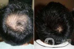 fue植發(fā)缺點(diǎn)和優(yōu)點(diǎn)分別是什么