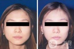 打完*能維持多長時(shí)間