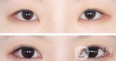 開眼角手術(shù)醫(yī)院介紹？開眼角哪好？