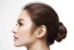 在武漢做專(zhuān)業(yè)隆鼻修復(fù)多少錢(qián)