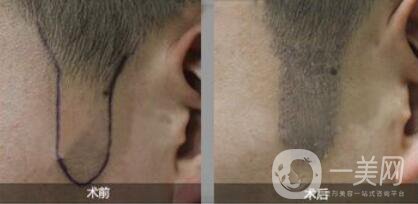 正規(guī)的醫(yī)院做植鬢角手術(shù)多少錢(qián)