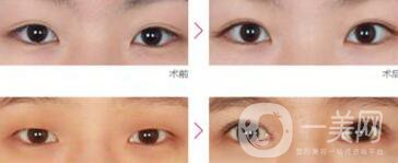 如果開眼角失敗該怎么辦