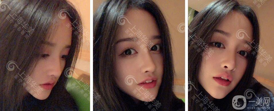 上海華美整形價格表2018發(fā)布 高級臉專屬定制項目曝光