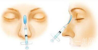 武漢注射隆鼻失敗修復(fù)價格多少