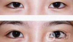 在濟(jì)南割雙眼皮費(fèi)用是多少