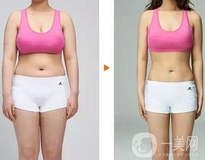 鐳射溶脂價(jià)格要多少錢？