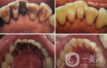 *潔牙好不好？*果可以維持幾年？
