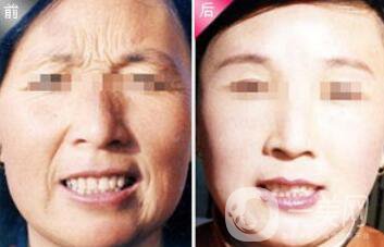 除皺注射雙美膠原蛋白多少錢(qián)一支