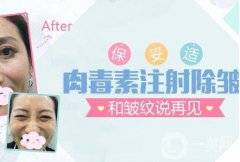 北京注射瘦臉注射去皺一般需要多少錢？