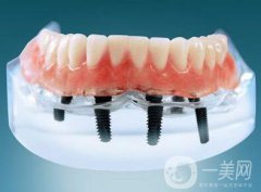 種植牙可以用多久？維持時間