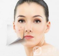 復合彩光祛痘印多久一次？