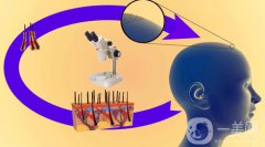 fut植發(fā)技術的優(yōu)點和缺點有哪些？