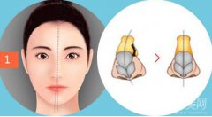 重慶歪鼻矯正一般需要多少錢 費(fèi)用解析