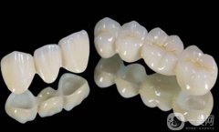 鈷鉻烤瓷牙好不好？可以保持多久？