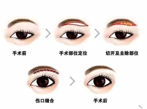 上海眉整形大概需要多少錢？