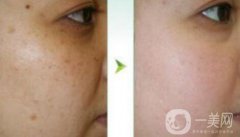 在正規(guī)醫(yī)院做飛頓彩光嫩膚果好嗎