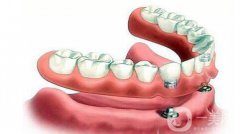 昆山種植牙價格一般是多少錢