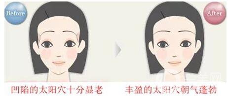 豐太陽穴,價格