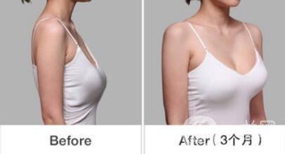 乳房下垂松軟怎么辦？可以做手術(shù)矯正嗎？