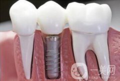 在寧波做人工種植牙一顆價格是多少