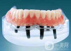 上海九院種植牙價格要多少錢？