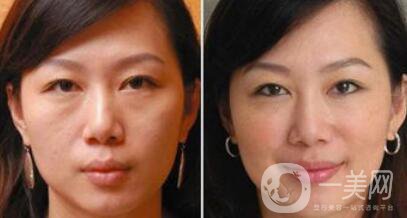 塑美極*果怎么樣？塑美極要做多少次？