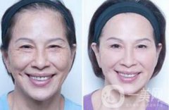 塑美極果怎么樣？塑美極要做多少次？