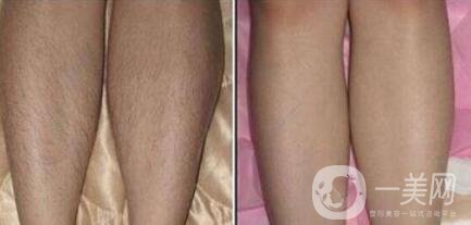 怎么去腿毛？*脫腿毛的方式是什么？