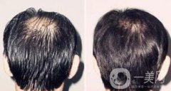 蛋白纖維植發(fā)好不好？植發(fā)解決頭發(fā)稀疏的問題