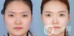 怎樣變瓜子臉？磨骨整形還是*？