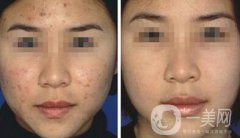 果酸換膚*嗎？果酸換膚要做幾個(gè)療程？