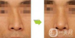 歪鼻矯正術(shù)難度大嗎？手術(shù)注意事項有哪些？