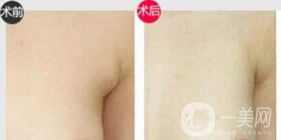 副乳切除什么時候進行比較好